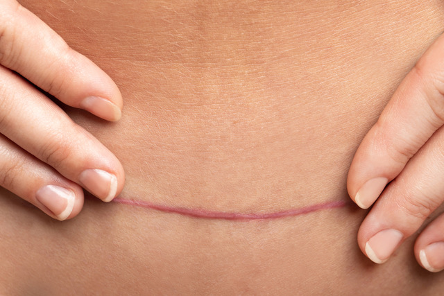 ScarWork treatment