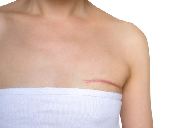 Scar tissue therapy